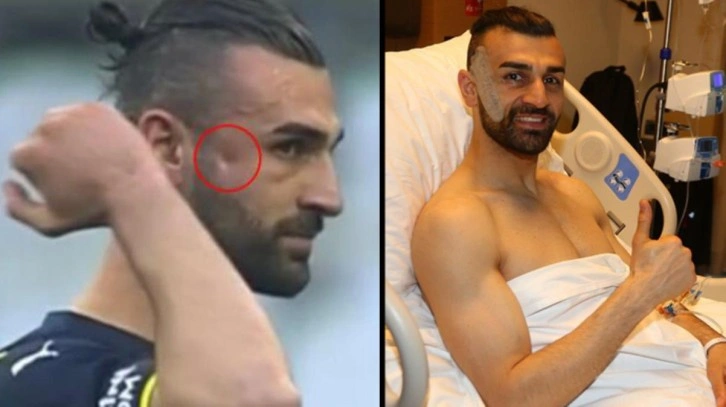 Elmacık kemiğine darbe alan Fenerbahçe'nin forveti Serdar Dursun ameliyat oldu