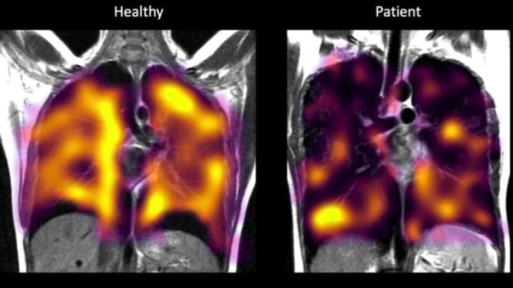 Uzun Covid: Yeni tarama tekniğiyle akciğerlerdeki gizli hasar tespit edilebildi