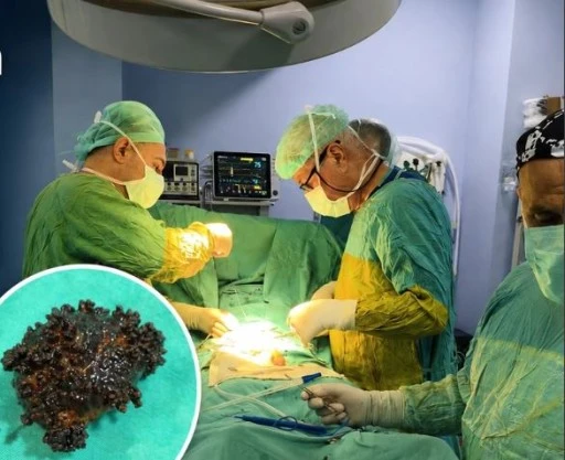88 Yaşındaki Hasta Mesane Taşından Ameliyatla Kurtuldu