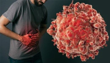 Dünyanın en sık görülen üçüncü kanser türü: Kalın bağırsak kanserine dikkat