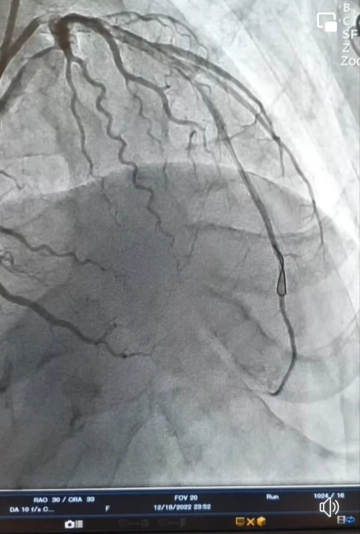 Hastanın kalp damarları Culotte stentleme tekniği ile açıldı