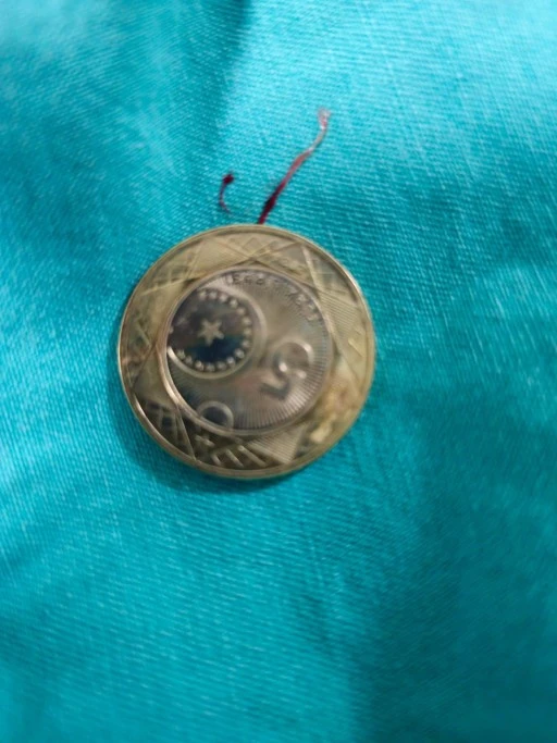 Siirt&rsquo;te 8 Yaşındaki &Ccedil;ocuğun Yuttuğu Madeni Para Başarıyla &Ccedil;ıkarıldı